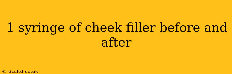 1 syringe of cheek filler before and after