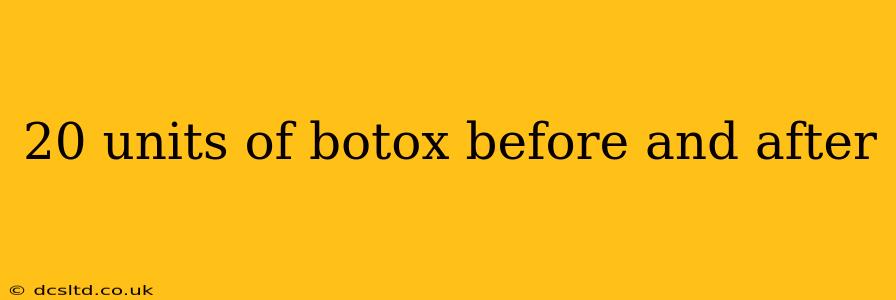 20 units of botox before and after