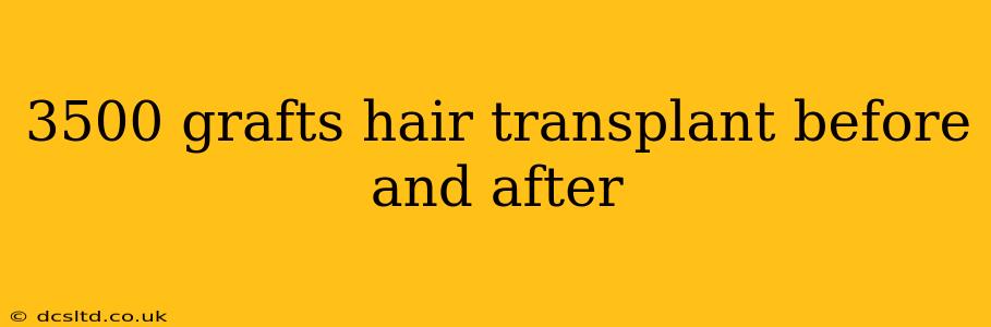 3500 grafts hair transplant before and after