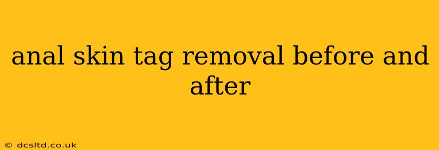 anal skin tag removal before and after