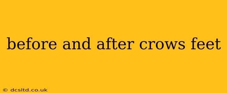 before and after crows feet