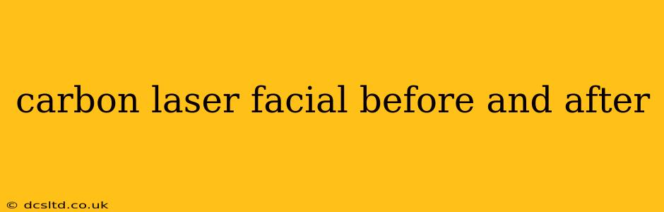 carbon laser facial before and after