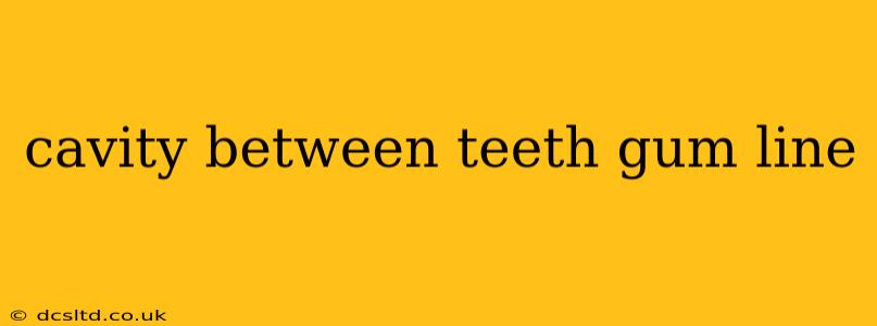 cavity between teeth gum line
