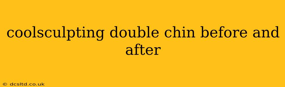coolsculpting double chin before and after