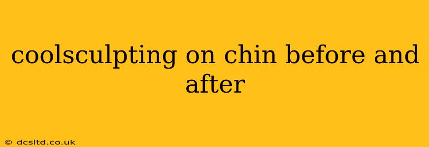 coolsculpting on chin before and after