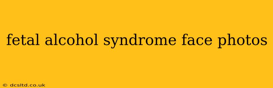 fetal alcohol syndrome face photos