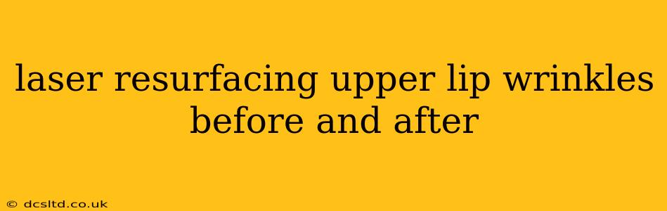 laser resurfacing upper lip wrinkles before and after