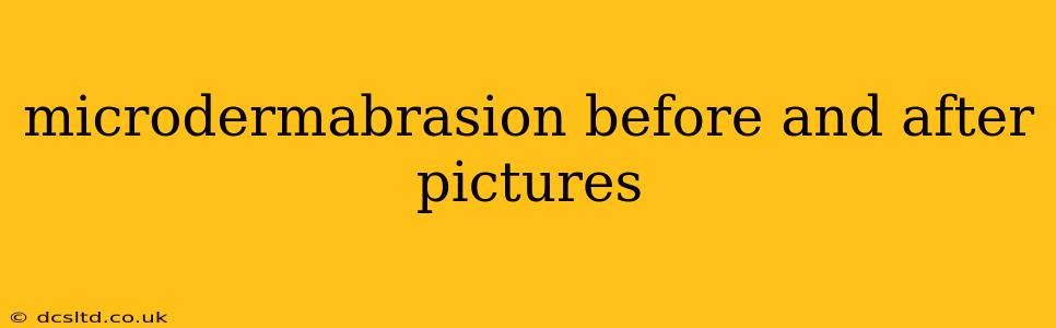 microdermabrasion before and after pictures