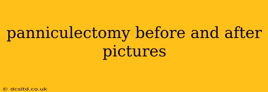 panniculectomy before and after pictures