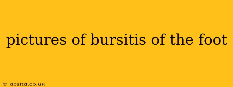 pictures of bursitis of the foot