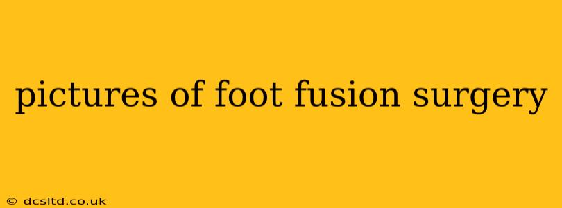 pictures of foot fusion surgery