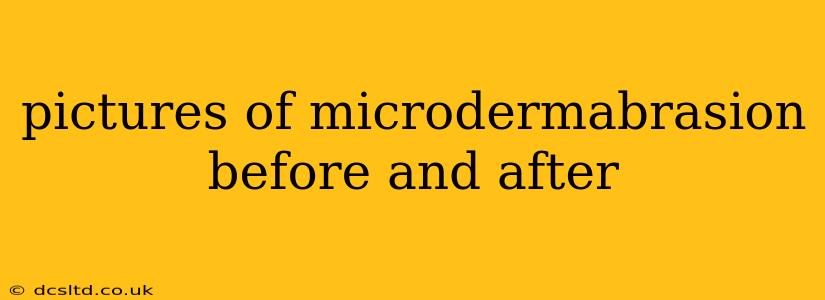 pictures of microdermabrasion before and after