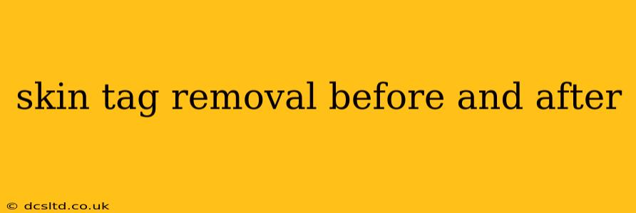 skin tag removal before and after