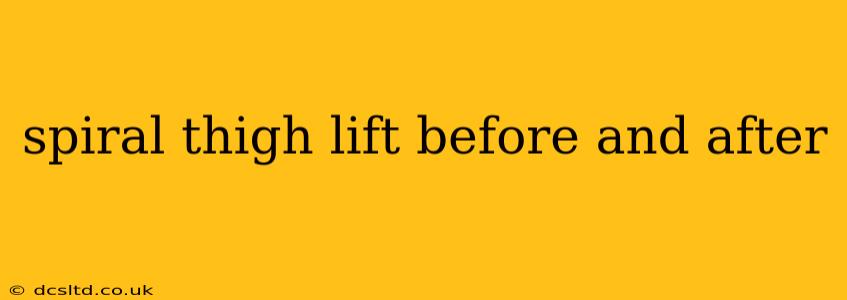 spiral thigh lift before and after