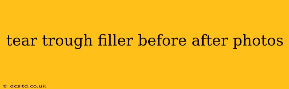 tear trough filler before after photos