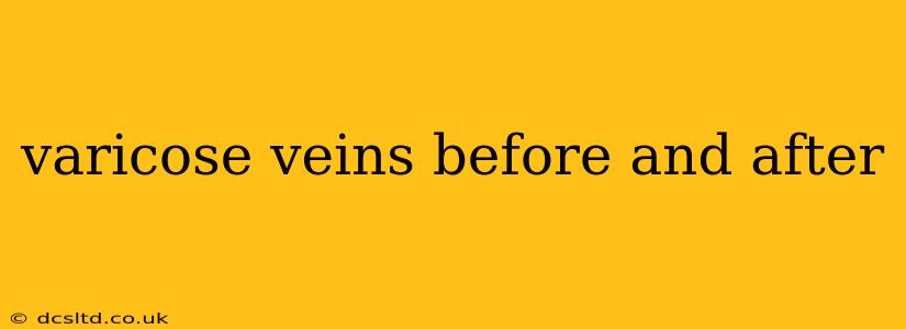 varicose veins before and after