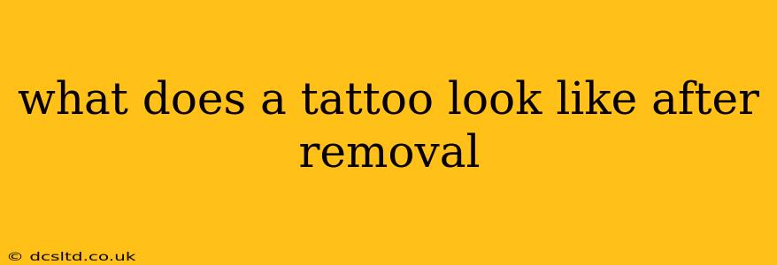 what does a tattoo look like after removal