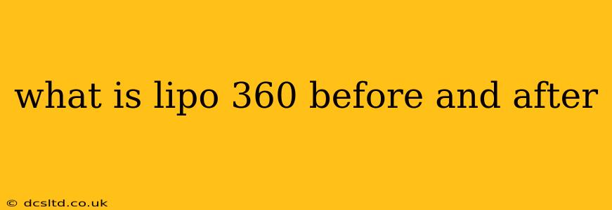 what is lipo 360 before and after
